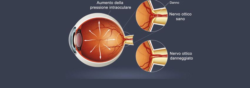 glaucoma