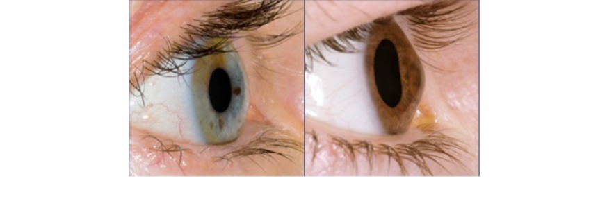 cheratocono cornea